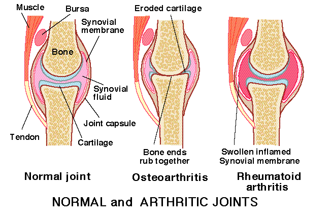 arthritic joint