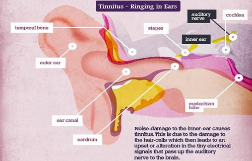 causes of tinnitus