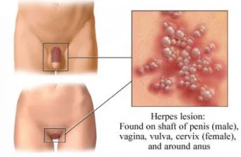What do herpes bumps look like what does herpes sores look like