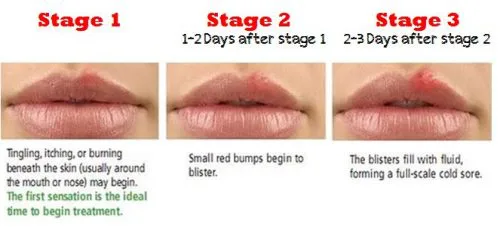 what does herpes look like on lips oral herpes blisters