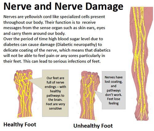 nerve damage in neuropathy
