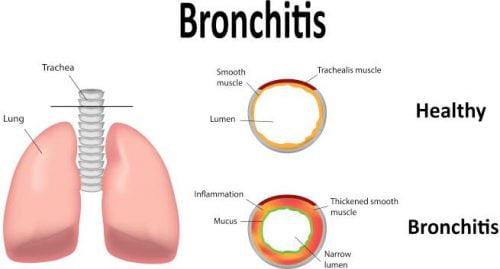 the cause of bronchitis